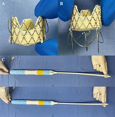 Transcatheter Mitral Valve-in-Valve Implantation With a New Transcatheter Heart Valve for Bioprosthetic Degeneration